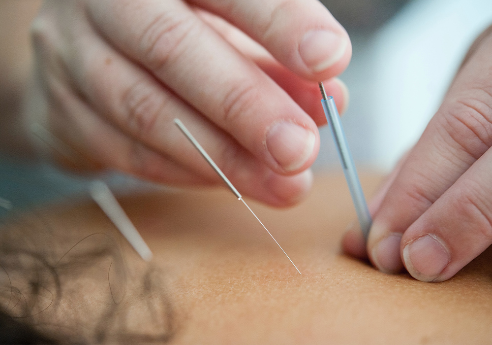 Acupuncture at the Pavilion Chichester